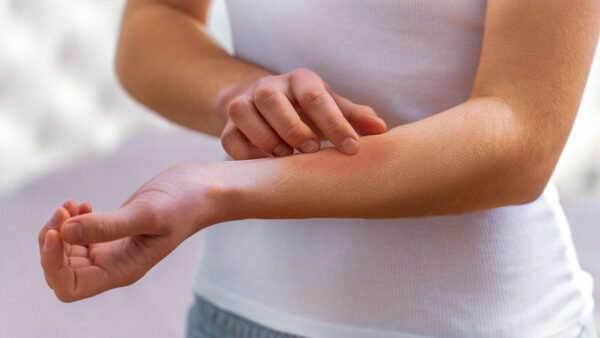 Алергиите и осипите се чест симптом на намалување на имунитетот.